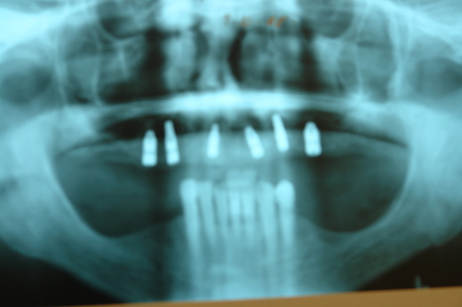 Zubní chirurgie - implantologie