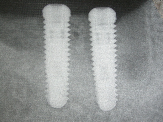 Zubní chirurgie - implantologie Zubní chirurgie - implantologie